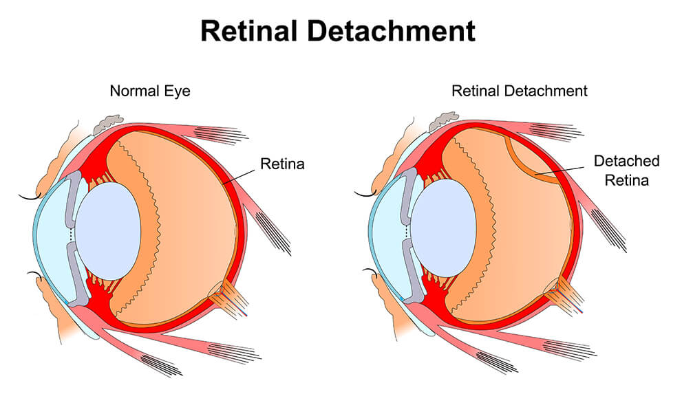 partially detached retina